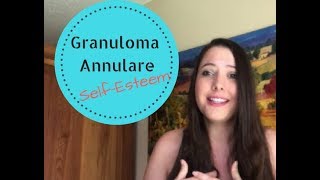 How to deal with Granuloma Annulare emotionally [upl. by Alis502]