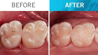 Step by step ONE Shade restoration with Venus Pearl ONE by Dr Zorzin EN [upl. by Rebba]