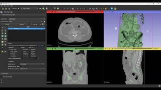 Threshold segmentation using slicer 3D [upl. by Enrico]