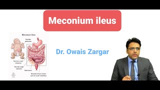 Topic  MECONIUM ILEUS  Surgery Simplified by DrOwais Zargar [upl. by Orpha]