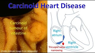 Carcinoid Heart Disease [upl. by Land]