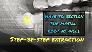 When the Mesial Root is Stuck Step by Step Wisdom Tooth Extraction Video with Instruments Listed [upl. by Ardnassela]