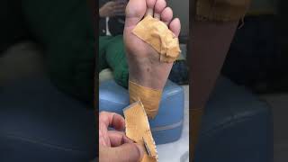 Callus treatment Callus removal from feet ep110 Cao​Clinic [upl. by Raine228]