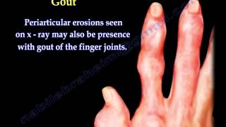 Arthritis Of The Fingers types and patterns  Everything You Need To Know  Dr Nabil Ebraheim [upl. by Fillander719]