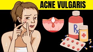 Acne Vulgaris  Causes Risk Factors Signs And Symptoms And Various Treatment Options [upl. by Selassie647]