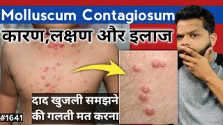 Molluscum Contagiosum Treatment In Hindi  Molluscum Contagiosum Causes And Symptoms [upl. by Lime26]