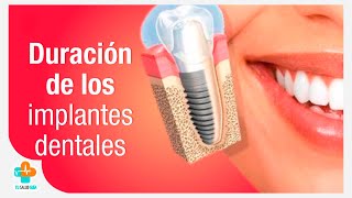 Duración de los implantes dentales  Tu Salud Guía [upl. by Ylram]