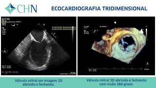 Conheça o exame de ecocardiografia tridimensional [upl. by Fletch310]