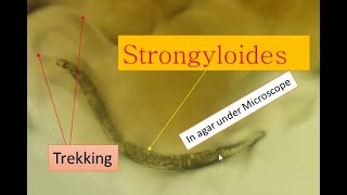 Strongyloidiasis cause and its pathogenesis Strongyloides under microscope [upl. by Lainey]