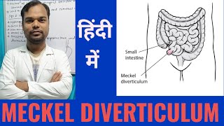 What is Meckel Diverticulum  Causes Symptoms amp treatment in hindi [upl. by Ahcorb]