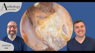 ITCHY EAR CANALS FIXED amp ANTERIOR RECESS EAR WAX REMOVAL  EP846 [upl. by Mellicent200]