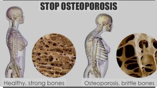 OsteopeniaampOsteoporosisDiagnosis through DEXA SCANOsteoporosisOsteopenia [upl. by Sussi]