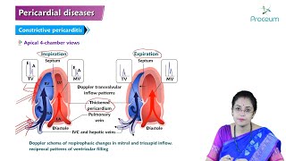 Pericardial Disease Hindi  Etiology Clinical Features Diagnosis Treatment and Complications [upl. by Nylyram]