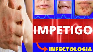 IMPETIGO  TIPOS SINTOMAS DIAGNÓSTICO E TRATAMENTO  COMO TRATAR IMPETIGO  IMPETIGO TRATAMENTO [upl. by Drofxer]