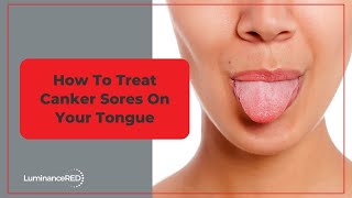 How to Treat Canker Sores on Your Tongue [upl. by Aileme]