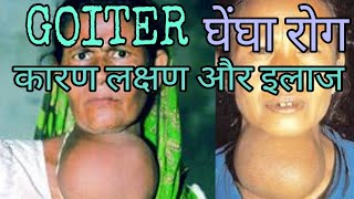 Goiter treatment symptoms cause in hindi [upl. by Zehe]