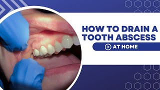 How To Drain A Tooth Abscess At Home Using Home Remedies [upl. by Fayre]