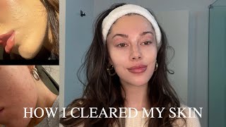 How I cleared my skin [upl. by Helaine]