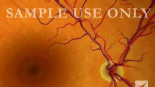 Eye Retinal Artery Damage [upl. by Nipsirc]