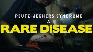 Living with PeutzJeghers syndrome  A short doc [upl. by Eenat]