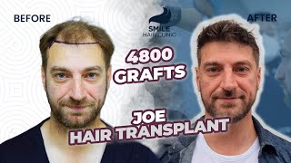 Turning Back the Clock Incredible Results of a 4800 Graft Hair Transplant  Before and After [upl. by Spencer]