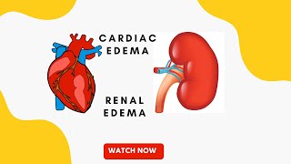 Cardiac edema vs renal edema  pathology  MBBS 2nd year [upl. by Nnyltak521]