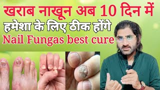 Kharab nakhoon 10 din mai hamesha ke liye thik hongeBest nail fungas herbal treatment [upl. by Franchot35]