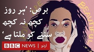 Vitiligo Girl quotYour worth is not decided by the marks on your skinquot  BBC URDU [upl. by Nylidam330]