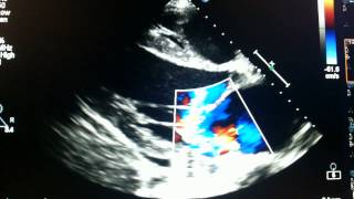 Ecocardiograma  Ruptura de cordolha de valva mitral Echocardiogram  Break cordolha mitral valve [upl. by Conners]