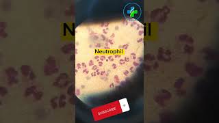 High neutrophil count in peripheral smear  neutrophils  CBC  Causes of Neutrophilia  hematology [upl. by Epuladaugairam528]