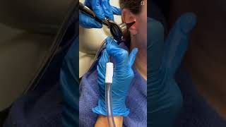 Ear wax removal using suction by an ENT [upl. by Kiersten468]