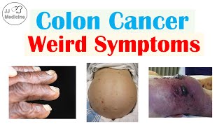 Colon Cancer Weird Symptoms amp Why They Occur [upl. by Kone947]