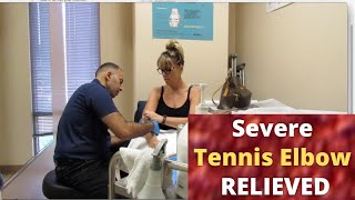 Extreme Tennis Elbow Pain Gone in Minutes with ASTR Devices [upl. by Dnamron]