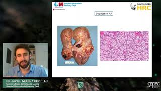 Diagnóstico y tratamiento del cáncer de riñón  Dr Javier Molina Cerrillo [upl. by Attirb]