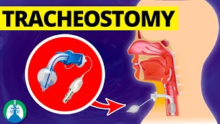 Tracheostomy Medical Definition  Quick Explainer Video [upl. by Nieberg]