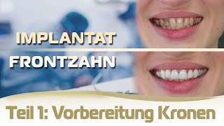 Implantat einsetzen Frontzahn Ablauf Teil 1  Vorbereitung für die Kronen und provisorische Brücke [upl. by Aseel]