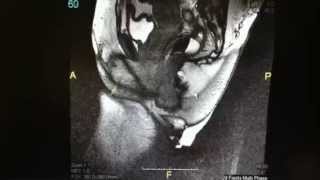 Magnetic Resonance Defecography Rectocele Cystocele [upl. by Orlantha995]