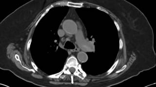 Pulmonary Embolism by NonContrast CT JETem 2017 [upl. by Nodnahs]