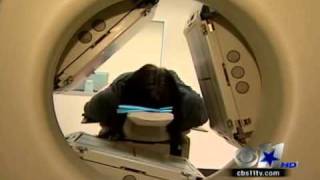 SPECT Brain Imaging for Bipolar Treatmentmp4 [upl. by Gokey]