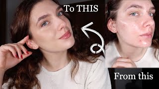 How to fake perfect skin on acne prone skin [upl. by Darleen66]