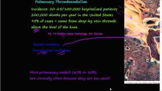 58PEtiology of Pulmonary embolism Saddle embolus Paradoxial embolism [upl. by Toffic]