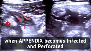 Ultrasound Complicated Perforated Appendicitis [upl. by Annadal366]