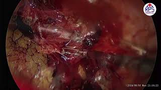 MANAGEMENT OF ECTOPIC PREGNANCY BY LAPAROSCOPY LAPAROSCOPIC SALPINGECTOMY [upl. by Erbua]