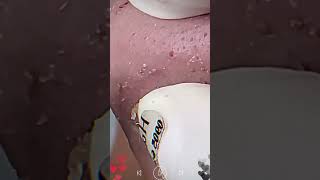 Skincare  Blackheads Removal 167 skincare skincare blackheads blackheads [upl. by Namrej198]