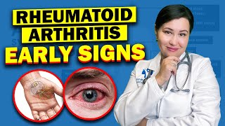 Early Warning Signs Of Rheumatoid Arthritis  Dont Ignore These Vital Symptoms [upl. by Attelrahc939]