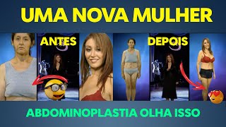 ABDOMINOPLASTIA ANTES E DEPOIS REACT [upl. by Silvia]