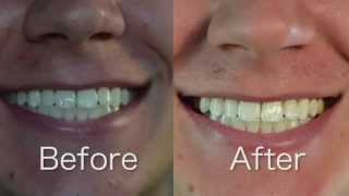 Crest 3D White Whitestrips 1 Hr Express Review and BeforeAfter [upl. by Ellac]