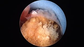 PCNL keyhole technique for kidney stone removal  दूरबीन द्वारा गुर्दे की पथरी का ऑपरेशन [upl. by Sturges]