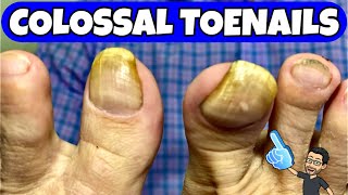 HUGE TOENAILS DEBRIDEMENT  LONG TIME NO SEE THE NIPPER [upl. by Anirad]