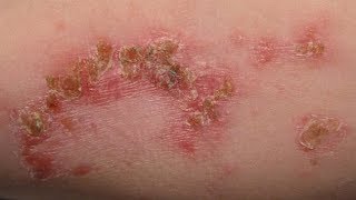 Impetigo Infecciones de la piel Costras en la piel [upl. by Alicsirp]